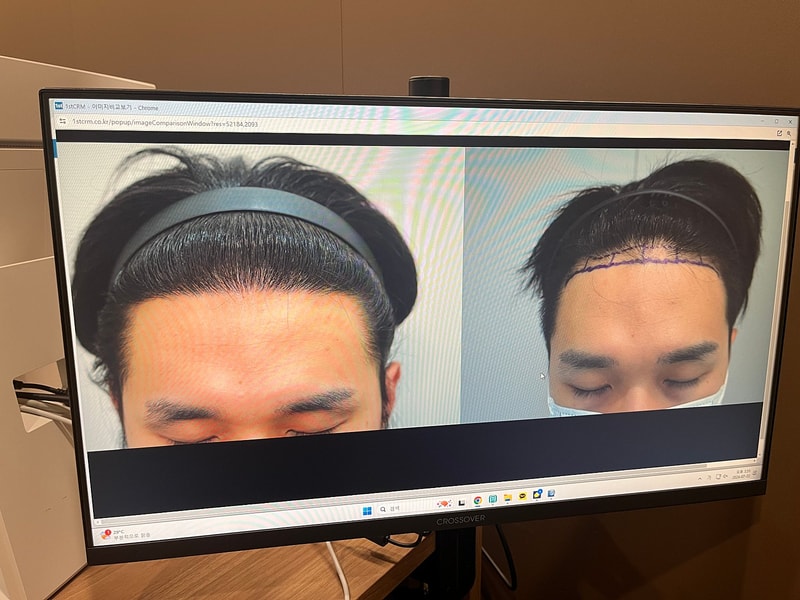 Grow Clinic (formerly Busan New Hair) Director Jang Tae-ho's hair transplant 1,500 hair follicles transplant in the first year