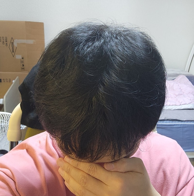 모발이식_6개월차.jpg