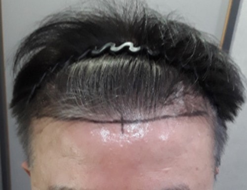 수술전에 앞모습이이랬네.jpg