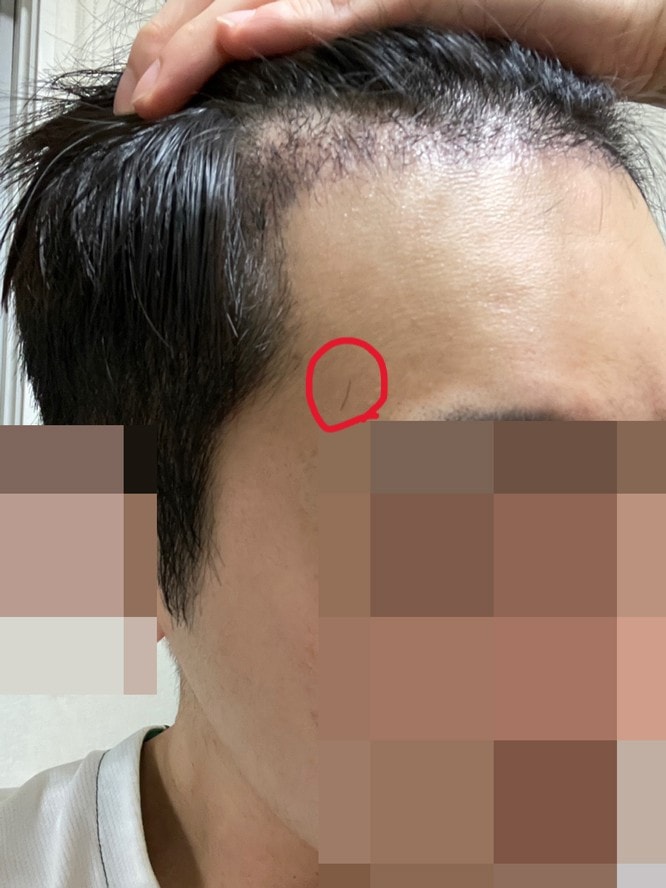 移植无剃头发的12个月后期！
