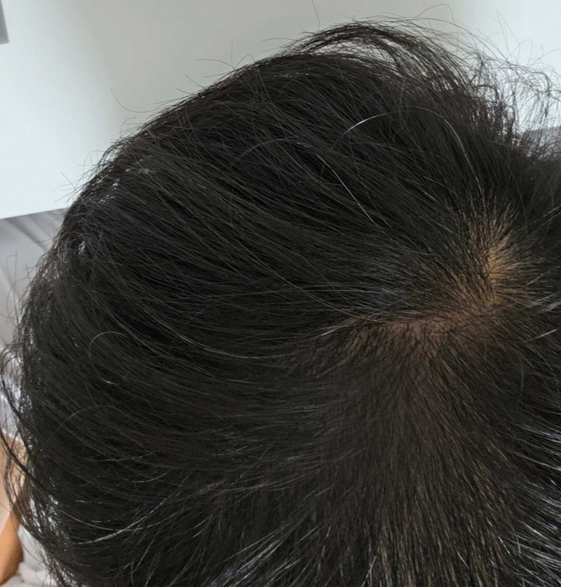 Mass hair transplant Dana plastic surgery clinic 2500 hair follicles 15 months old