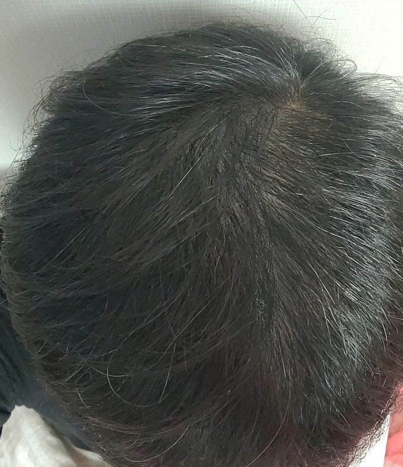 こんにちは。タナさんの頭頂部移植7ヶ月目です。