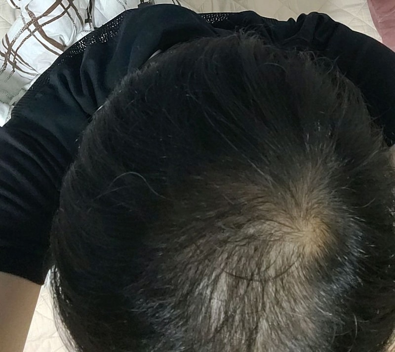 탈모_모발이식전.jpg