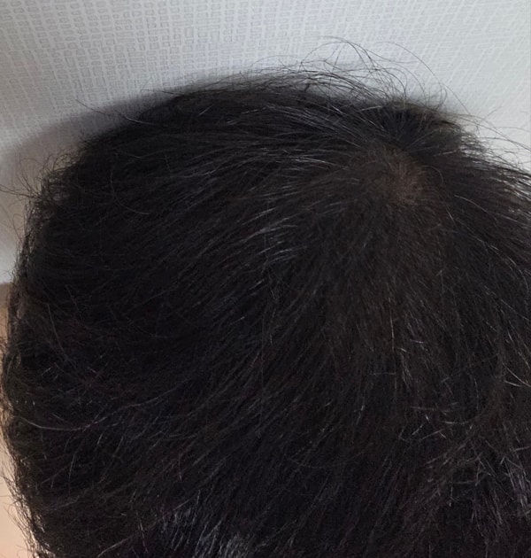 대량모발이식 다나성형외과 365일 경과