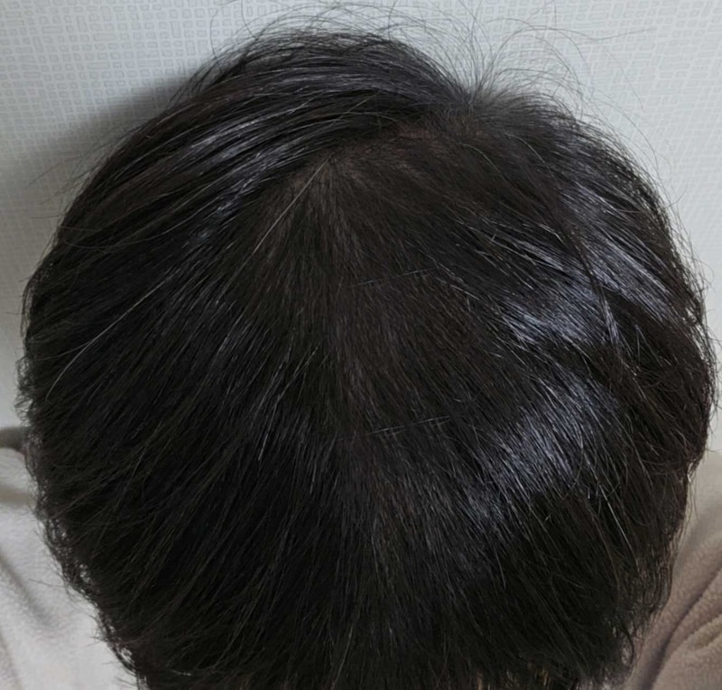다나성형외과 비절개 대량이식 16개월차를 보내며..