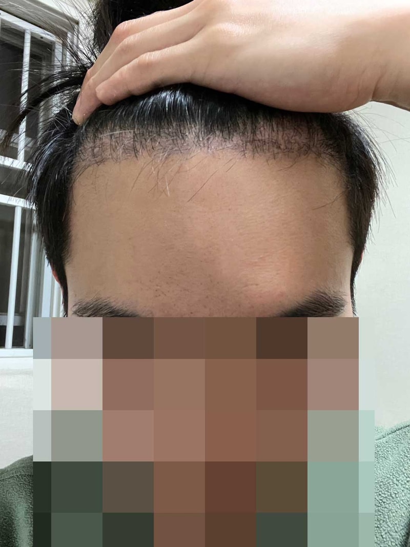 비절개모발이식_4개월차.jpg