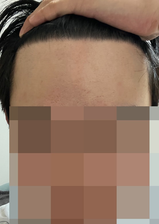 다나 무삭발 모발이식 1년1개월 경과ㅎㅎ