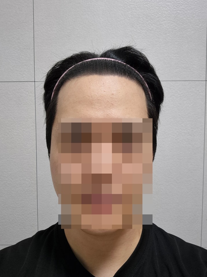 다나성형외과 비절개모발이식 11개월ㅎㅎ