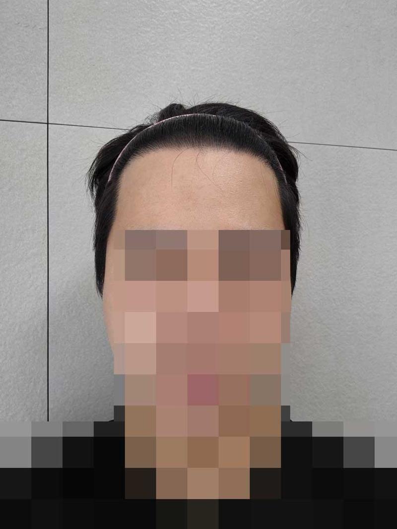 다나성형외과 비절개모발이식 8개월입니다 ㅎㅎ밀도와 디자인 모두 만족