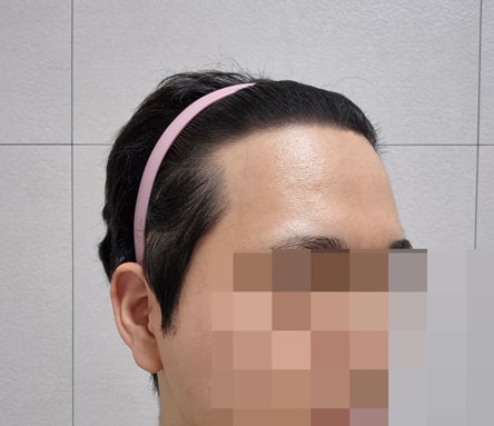 다나 비절개 10개월입니다ㅎㅎ모발이식에서 가장 중요한 건 밀도ㅎㅎ