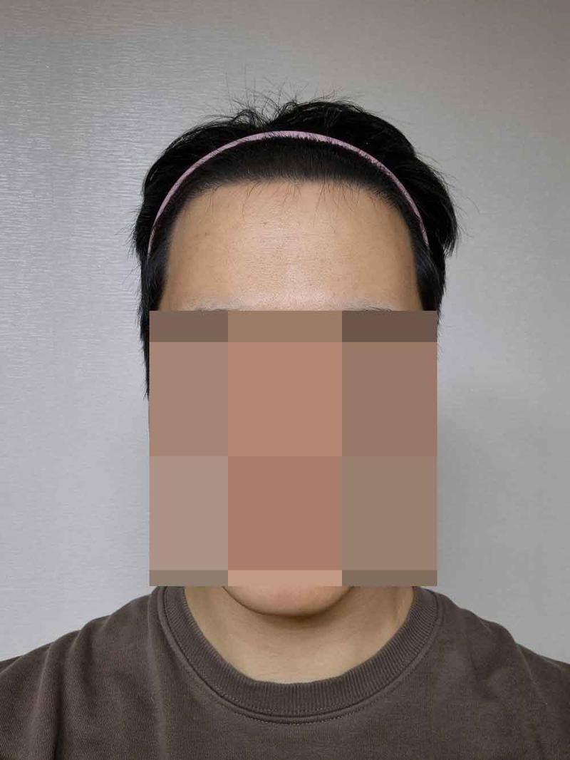 다나성형외과/비절개/5개월입니다 ㅎㅎ