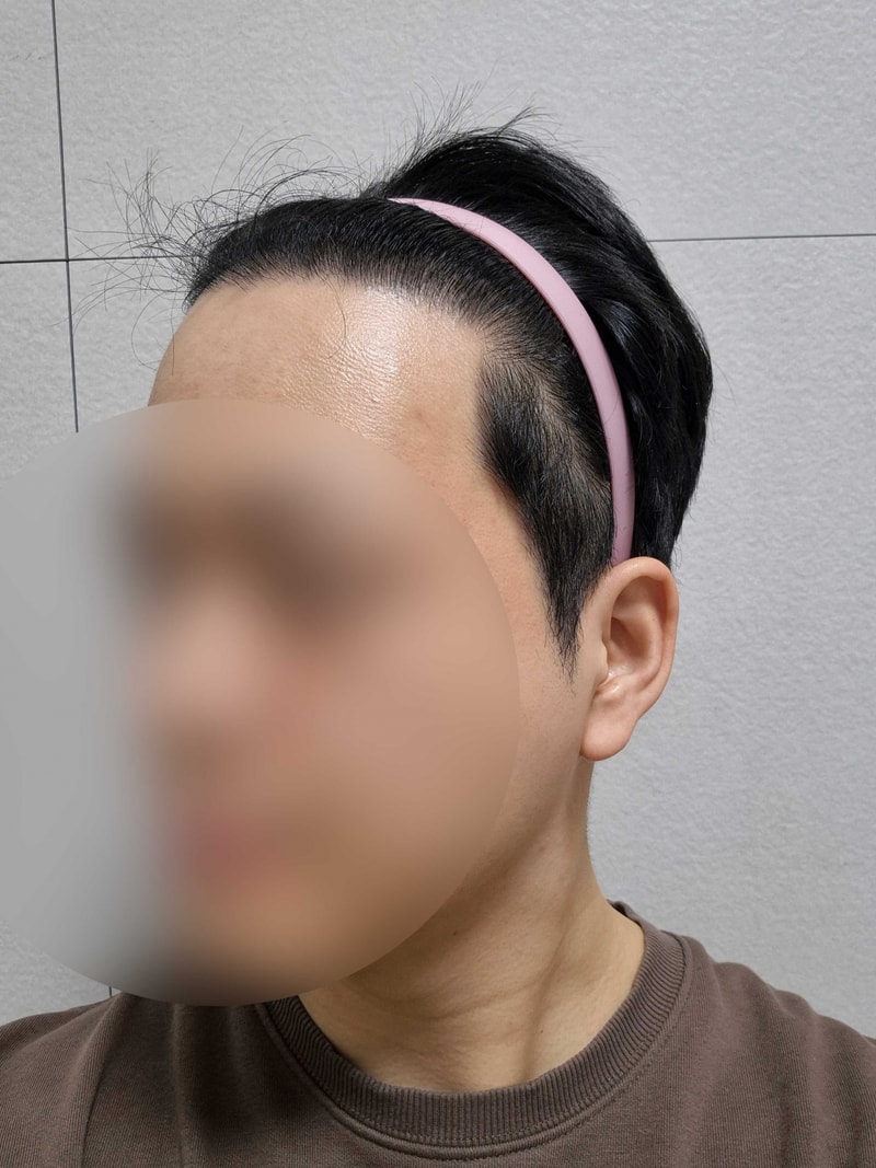 2400모 비절개모발이식 다나성형외과 15개월 후기