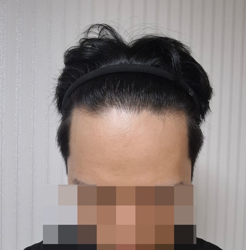 비포.jpg