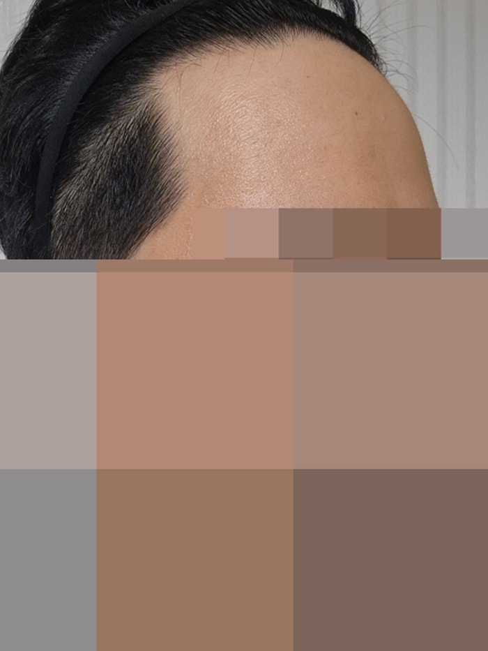 이식전ㅎ.jpg