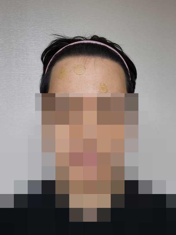 다나성형외과/비절개/6개월입니다 ㅎㅎ