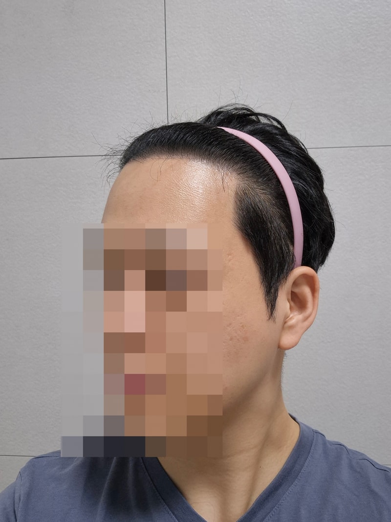 비절개모발이식 1200모낭했습니다.jpg