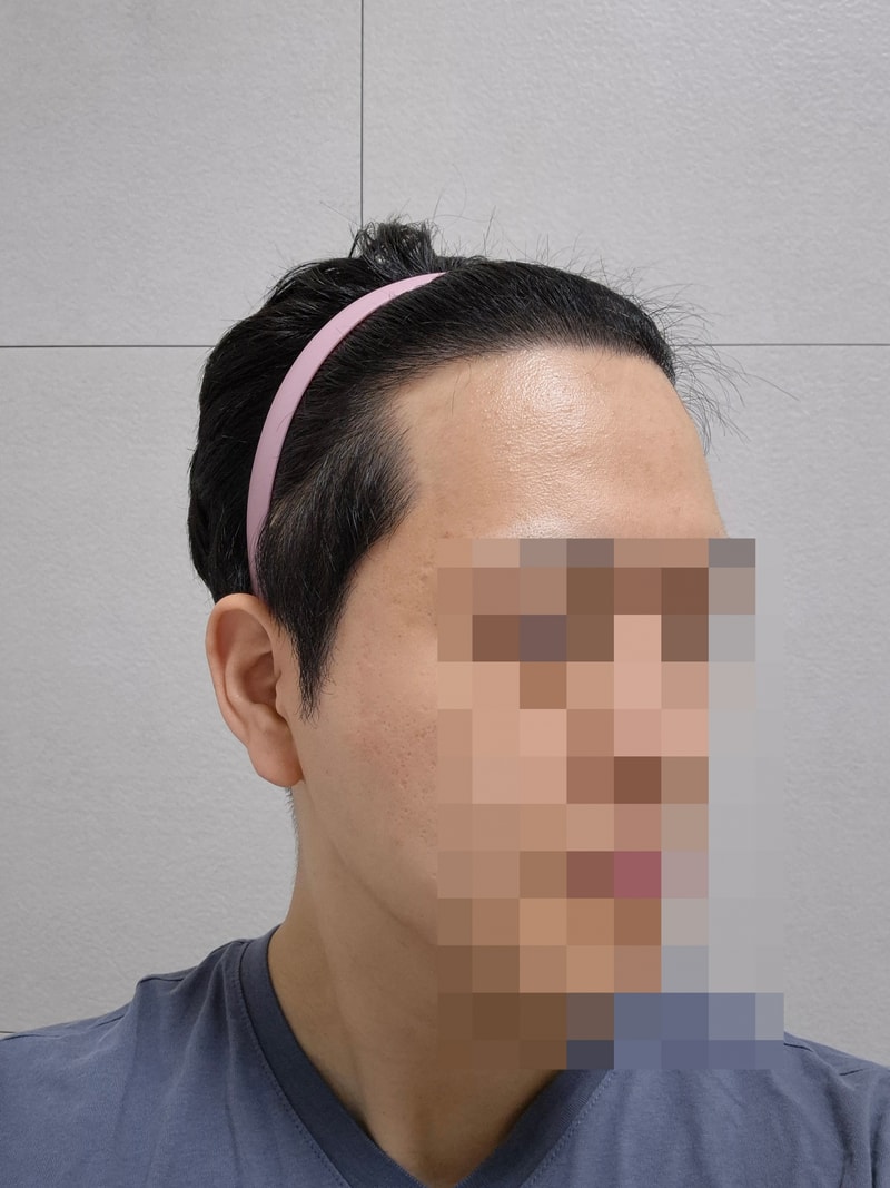 비절개모발이식1년후.jpg