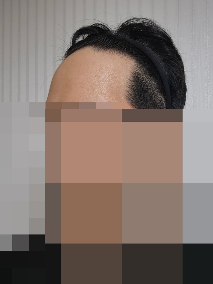 모발이식은 자존감을 찾아가는 과정이라고 생각합니다ㅎㅎ다나 비절개 9개월ㅎㅎ