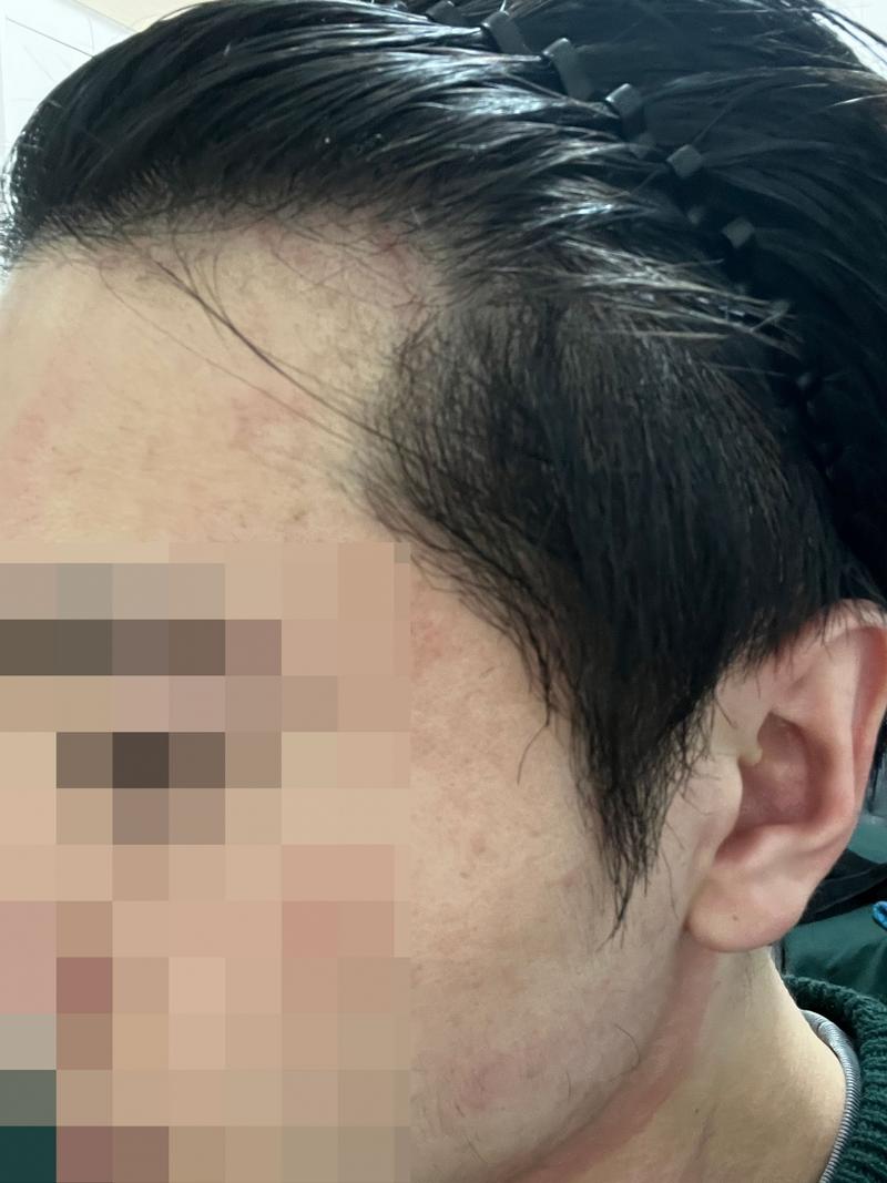 ダナ整形外科 無削髪 非切開毛髪移植6ヶ月目..!!!
