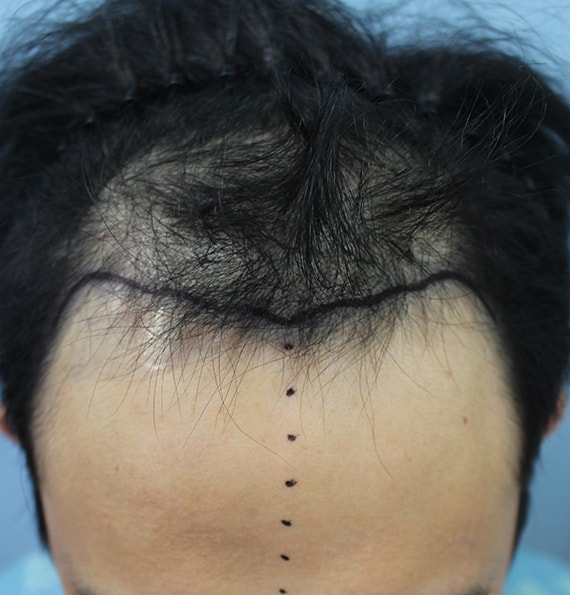 Evaluation of Interim Inspection of Hair Transplantation for Forehead Hair Loss