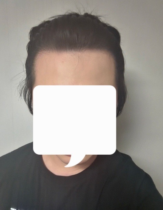 엠자탈모 찐으로 깊었던 30대입니다ㅋㅋ 다나 비절개 13개월