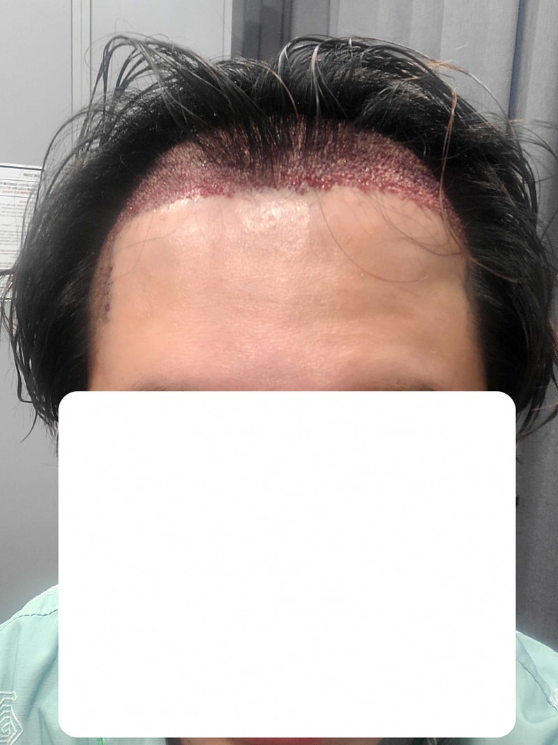 무삭발비절개 17개월 다나성형외과 5600모 후기