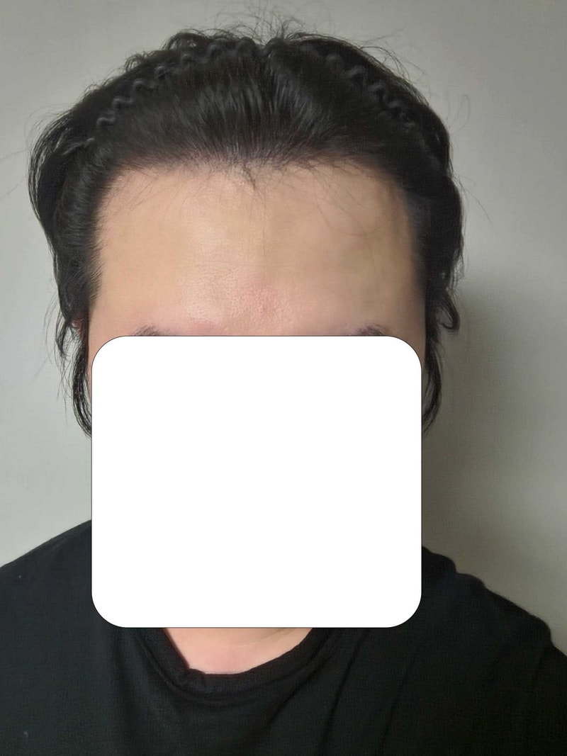 모발이식후16개월차.jpg