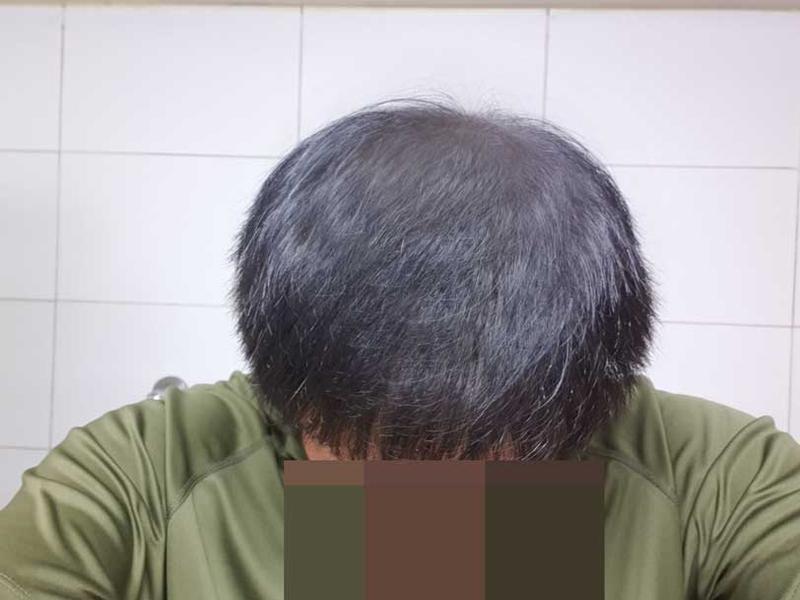 ハゲ男から脱出？ 脱出!! 大量毛髪移植ダナ整形外科9ヶ月、、ww