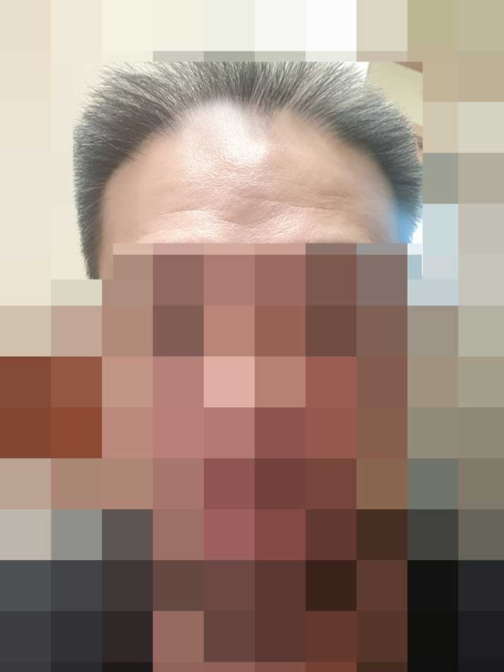 1.모발이식수술전에앞모습.jpg