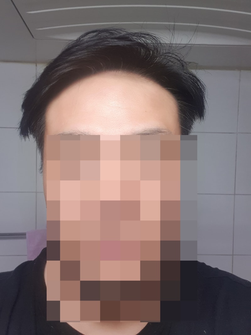 모발이식_1년차.jpg