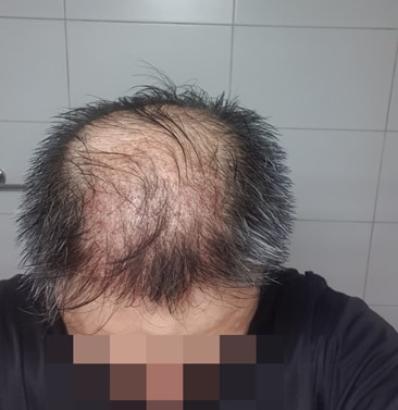 머리심는비용 하나두 안아깝다! 다나성형외과 비절개 11개월