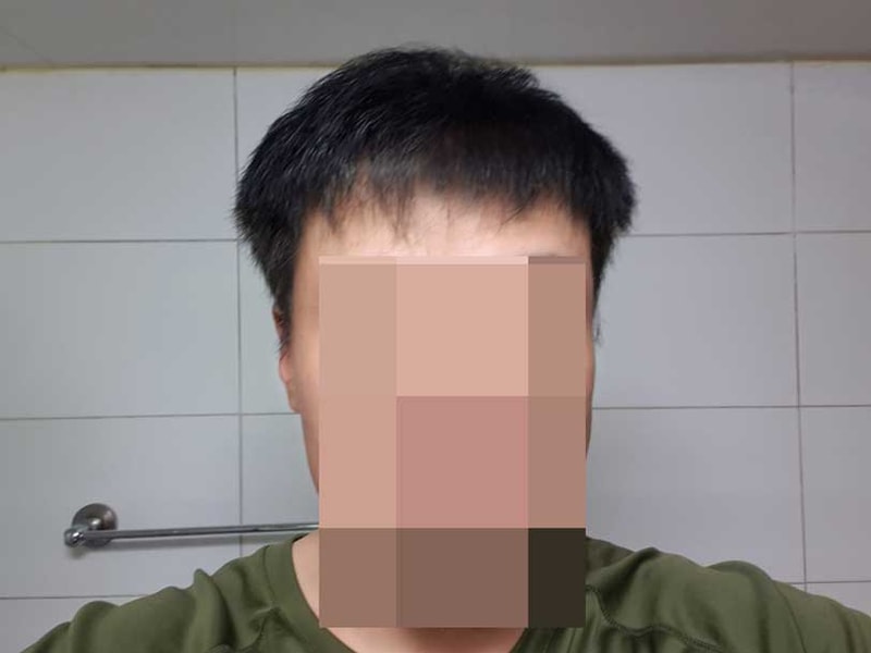 모발이식9개월차.jpg