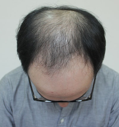 다나성형외과 4000모낭 4개월 후기!