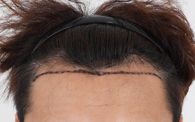 Please look at the density of the non-excisional 2100 hair transplant