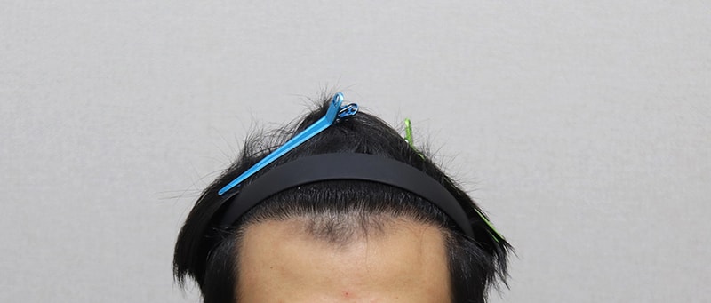 6.IMG_12476개월 경과.JPG