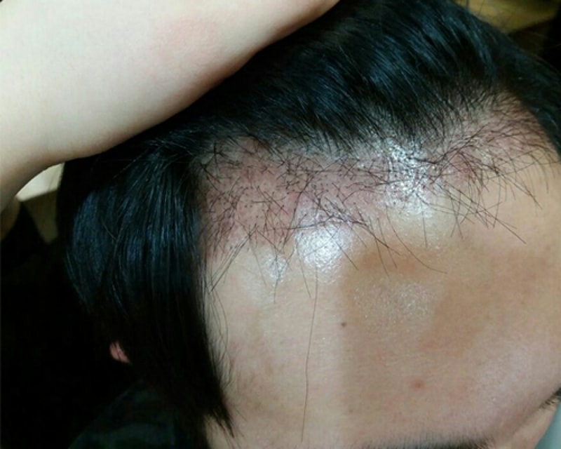 수술후5주2.jpg