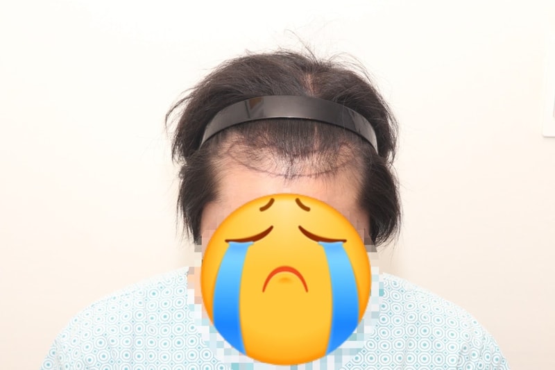 This is the review of non-cut hair transplantation on the 5th day of New Hair Hair Transplantation Hospital I did 1,600 hair follicles