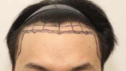 New Hair Day 5 incisional hair transplant 2200 hair follicles late stage