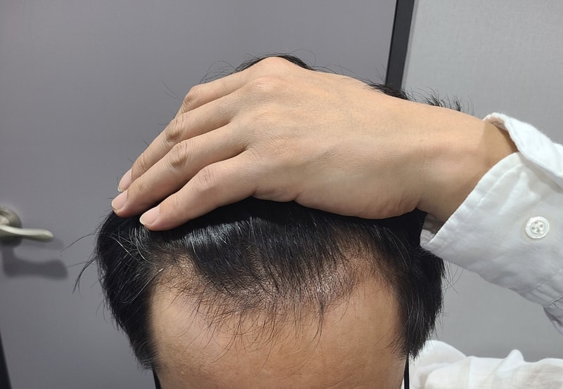 ダナ整形外科 無削髪 非切開手術完了後のレビュー