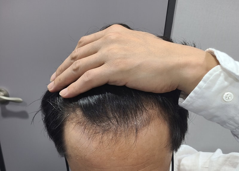 たなの木剃髪非切開移植10ヵ月。率直な感想です。
