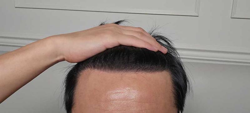 ダナ整形外科15ヶ月目です。 無削髪手術を大変おすすめ。