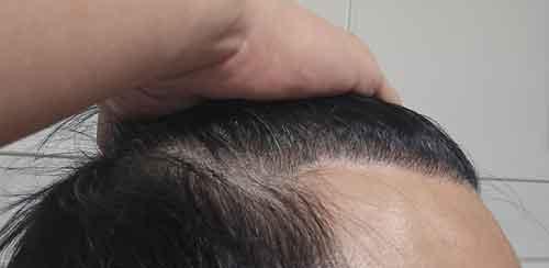 ダナ整形外科の無削髪非切開14ヶ月です。