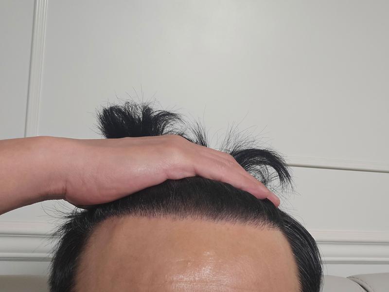 ダナ整形外科の無削髪非切開毛髪移植から1年が経ちました。 脱毛薬を継続して飲んでいる方に毛髪移植をお勧め。