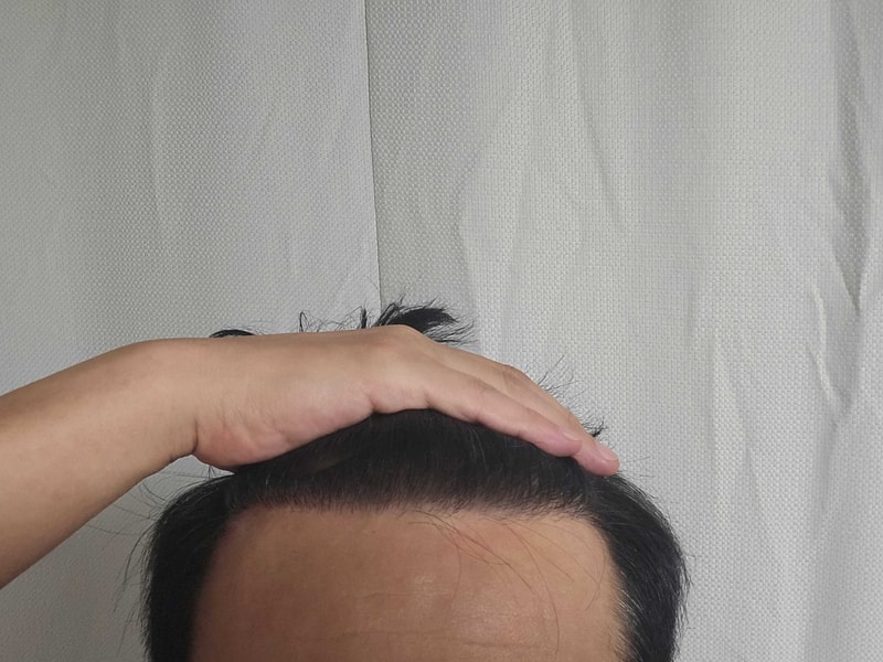 다나, 무삭발비절개, 3800모, 23개월차