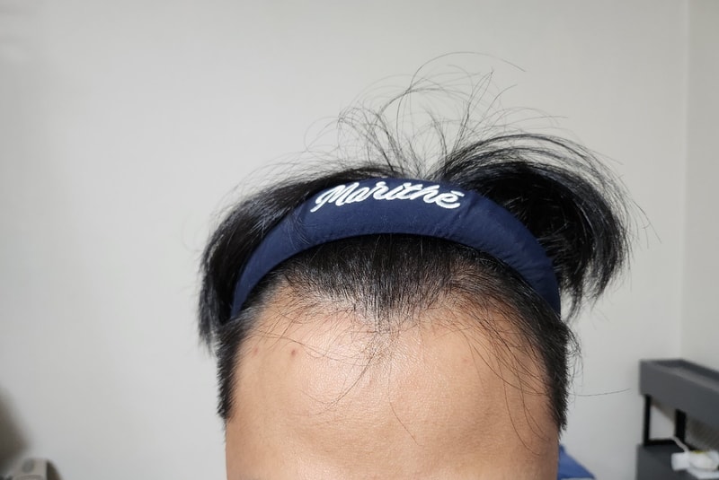 다나 무삭발 8개월. 성공이 보이는 것 같습니다