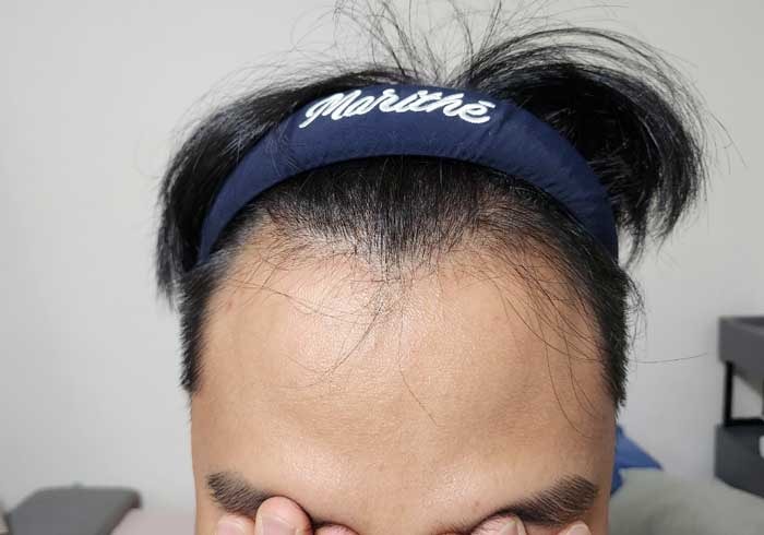 이식전 날것 그자체다.jpg