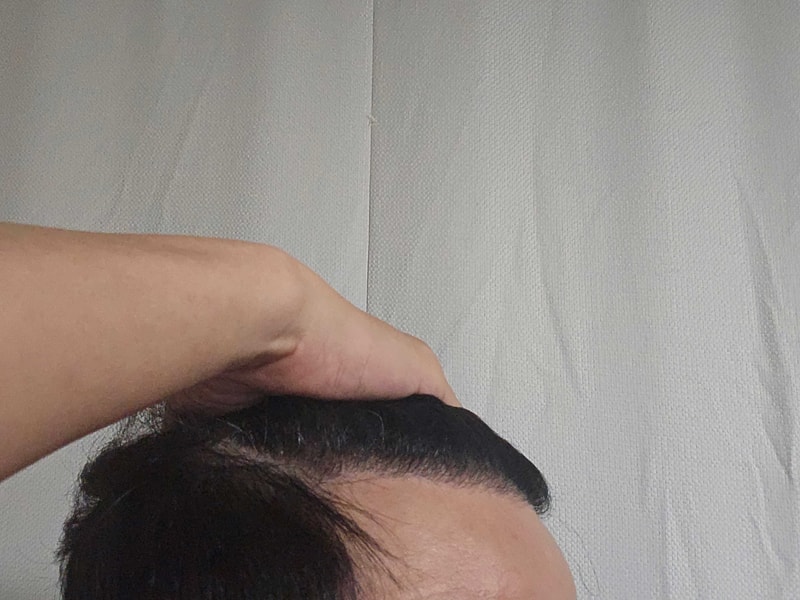 무삭발비절개 22개월.jpg