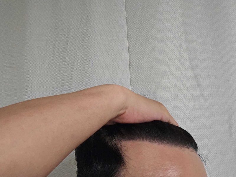 무삭발비절개 수술후.jpg