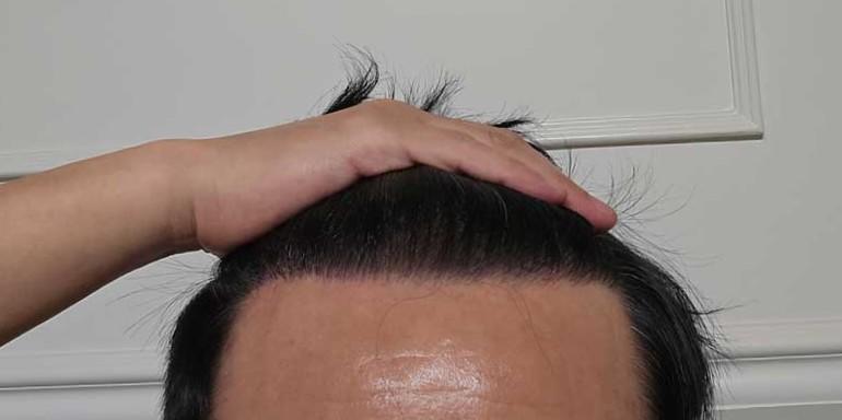 ダナ整形外科の無削足費切開17ヵ月、脱毛薬を必ず飲んでください 脱毛薬のおすすめ。