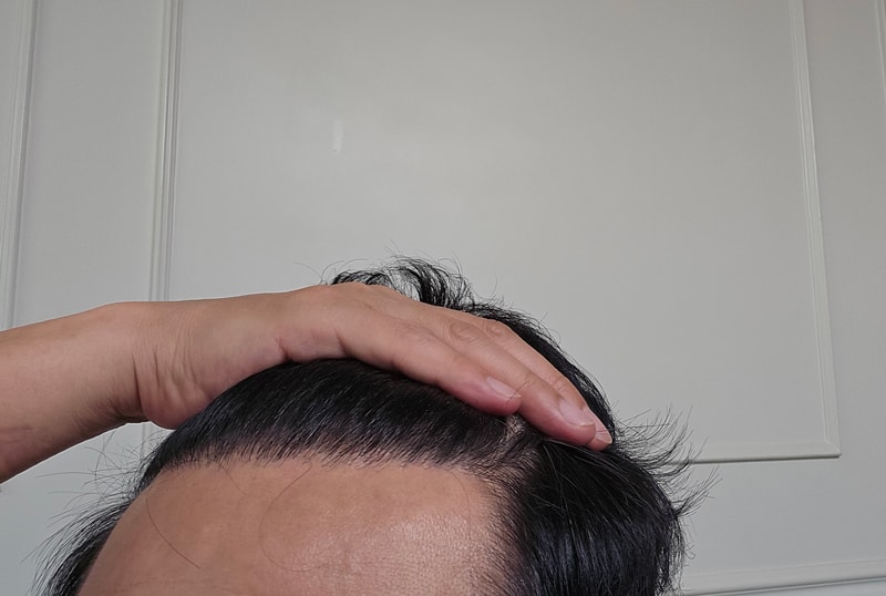 다나성형외과 무삭발비절개 20개월입니다.